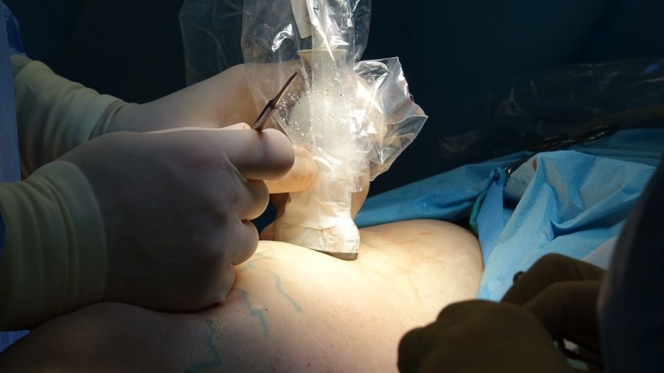 Peripheral Endovascular Intervention — illustrative image
